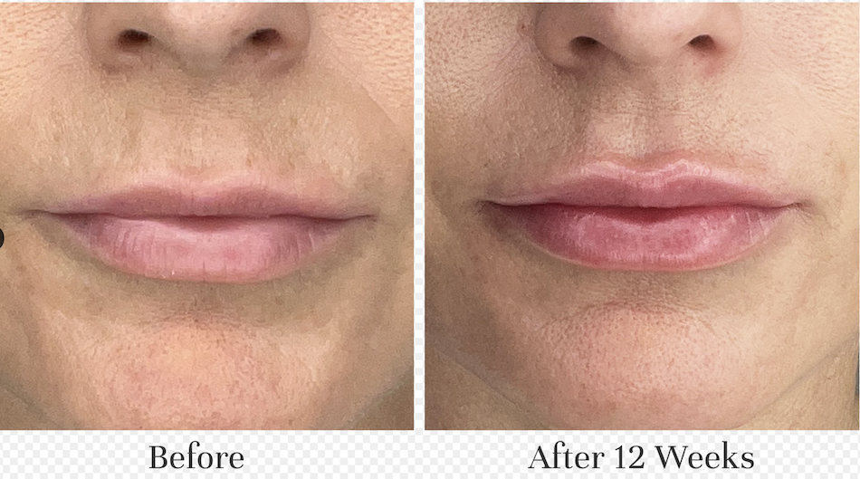 city lips before after results 